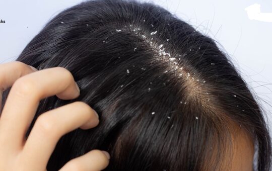 How to Get Rid of Dandruff; Winter Special?