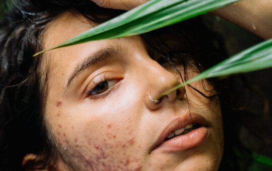 Effective Home Remedies for Treating Fungal Acne A Comprehensive Guide