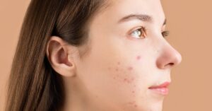 Effective Home Remedies for Treating Fungal Acne A Comprehensive Guide1